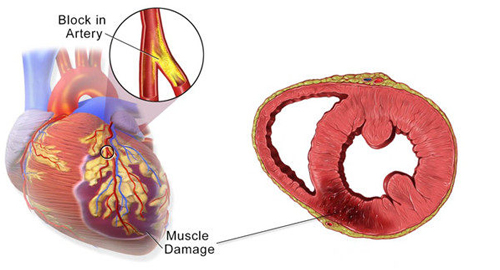 Sur L'infarctus Du Myocarde